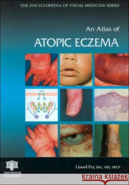 An Atlas of Atopic Eczema Lionel Fry Fry Fry 9781842142363 Taylor & Francis Group - książka