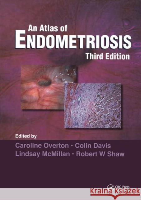 An Atlas of Endometriosis Overton, Caroline 9780415395731 Informa Healthcare - książka