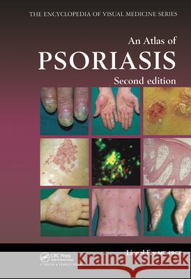 An Atlas of Psoriasis, Second Edition Laurie Kelly Lionel Fry 9781842142370 Taylor & Francis Group - książka