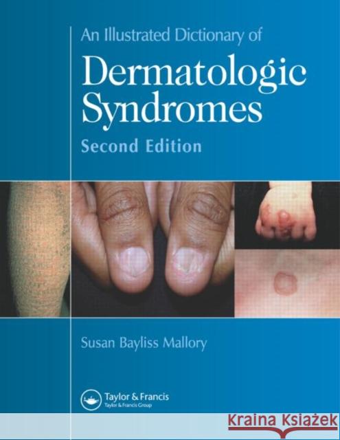 An Illustrated Dictionary of Dermatologic Syndromes Susan Bayliss Mallory 9781842142462 Taylor & Francis Group - książka