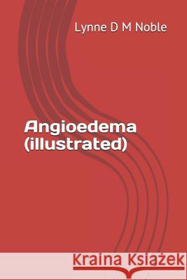 Angioedema (Illustrated) Lynne D. M. Noble 9781796586824 Independently Published - książka