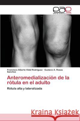Anteromedialización de la rótula en el adulto Vidal Rodriguez Francisco Alberto 9783659094521 Editorial Academica Espanola - książka