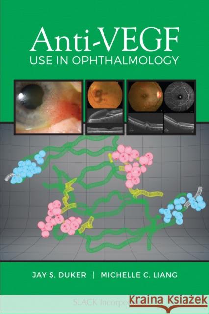 Anti-Vegf Use in Ophthalmology Jay S. Duker Michelle C. Liang 9781630913212 Slack - książka