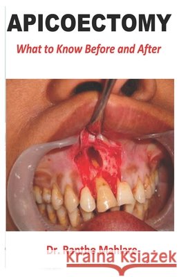 Apicoectomy: What to Know Before and After Mahlare, Rantho 9798695392197 Independently Published - książka