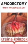 Apicoectomy: What to Know Before and After Mahlare, Rantho 9798695392197 Independently Published