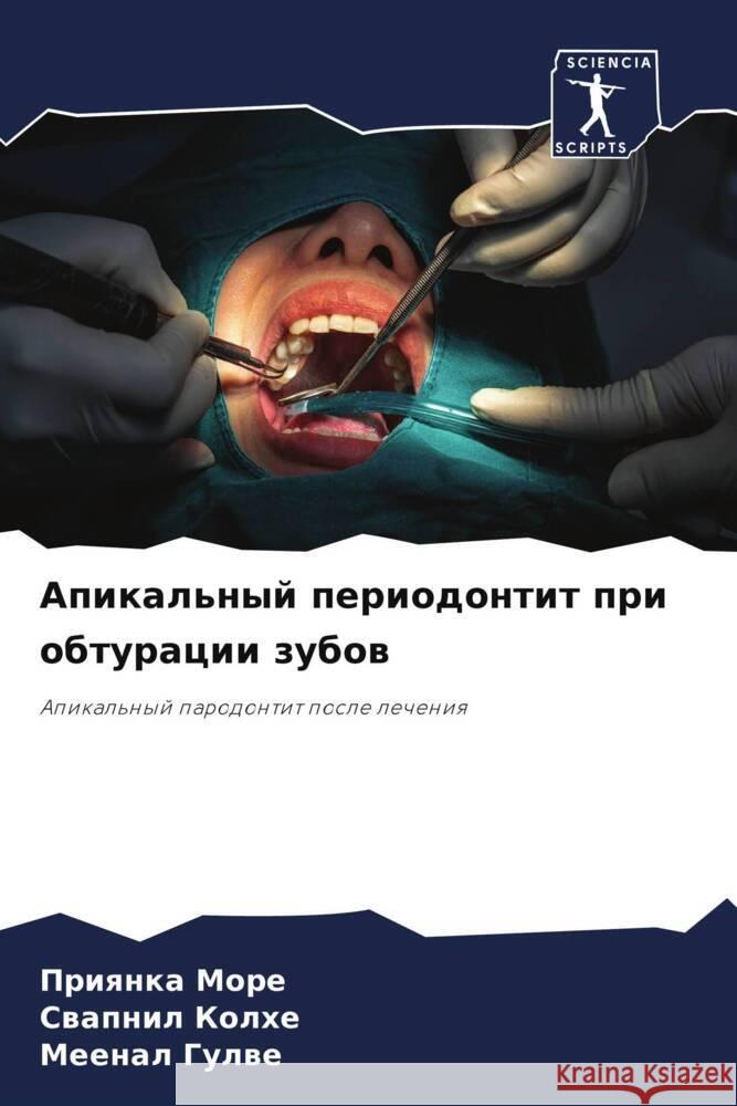 Apikal'nyj periodontit pri obturacii zubow More, Priqnka, Kolhe, Swapnil, Gulwe, Meenal 9786208047214 Sciencia Scripts - książka