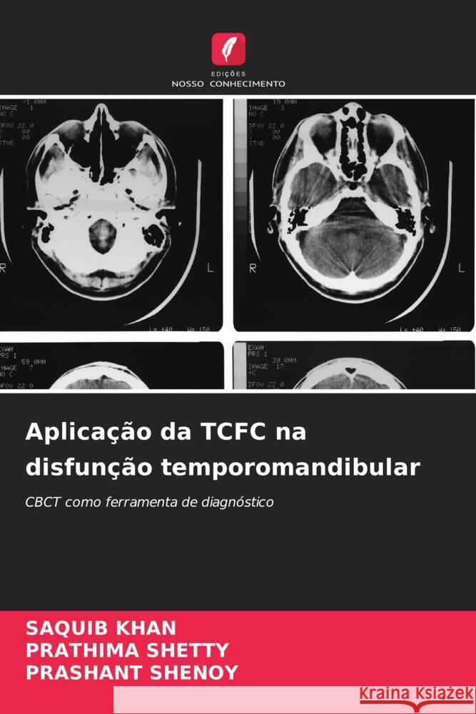 Aplica??o da TCFC na disfun??o temporomandibular Saquib Khan Prathima Shetty Prashant Shenoy 9786206912804 Edicoes Nosso Conhecimento - książka