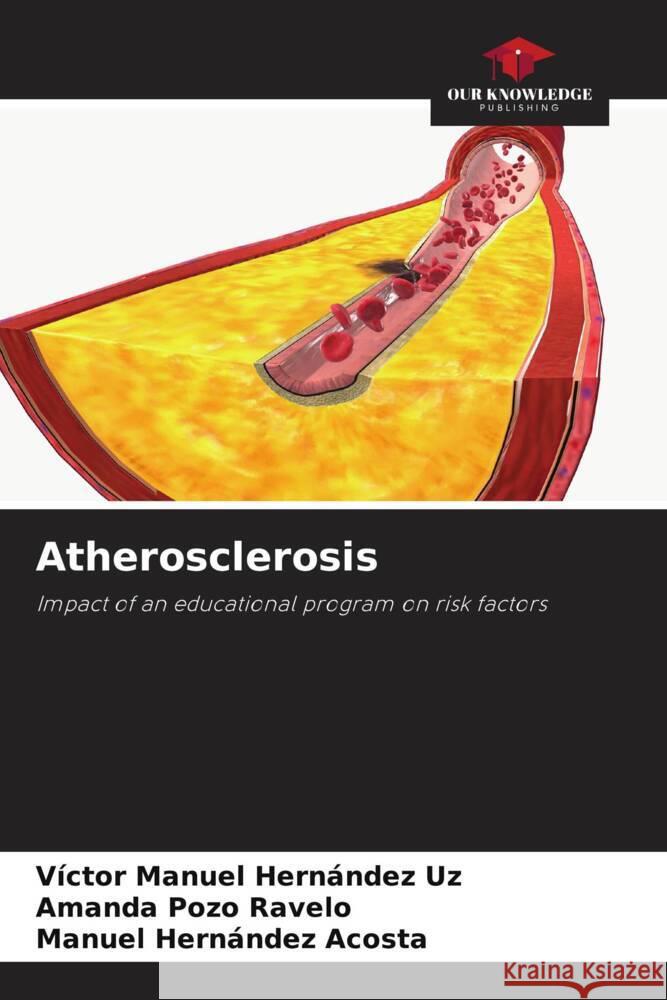 Atherosclerosis V?ctor Manuel Hern?nde Amanda Poz Manuel Hern?nde 9786207302499 Our Knowledge Publishing - książka