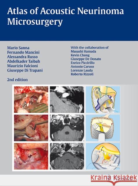 Atlas of Acoustic Neurinoma Microsurgery Sanna, Mario 9783131102829 Thieme Medical Publishers - książka