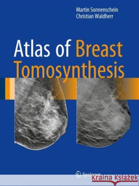 Atlas of Breast Tomosynthesis: Imaging Findings and Image-Guided Interventions Sonnenschein, Martin 9783319215655 Springer - książka