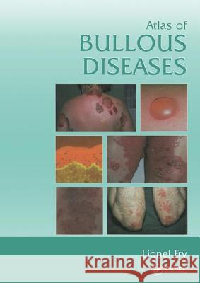Atlas of Bullous Diseases Lionel Fry 9780415383387 Informa Healthcare - książka