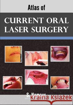 Atlas of Current Oral Laser Surgery S Namour 9781612330280  - książka