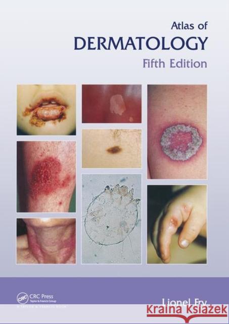 Atlas of Dermatology, Fifth Edition Lionel Fry John J. Voorhees 9781841845227 Taylor & Francis Group - książka