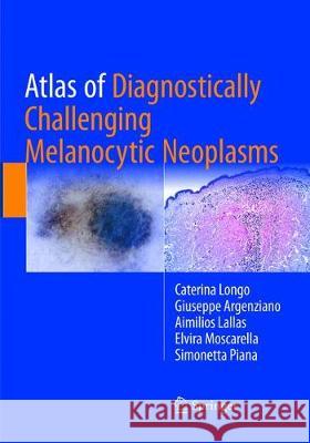 Atlas of Diagnostically Challenging Melanocytic Neoplasms Caterina Longo Giuseppe Argenziano Aimilios Lallas 9783319839868 Springer - książka