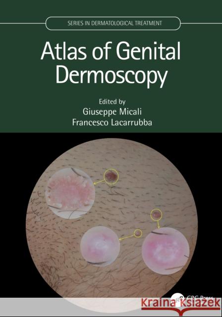 Atlas of Genital Dermoscopy Giuseppe Micali Francesco Lacarrubba 9780367440275 CRC Press - książka