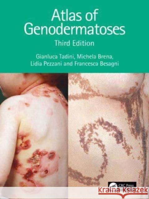 Atlas of Genodermatoses Lidia Pezzani 9780367643966 Taylor & Francis Ltd - książka