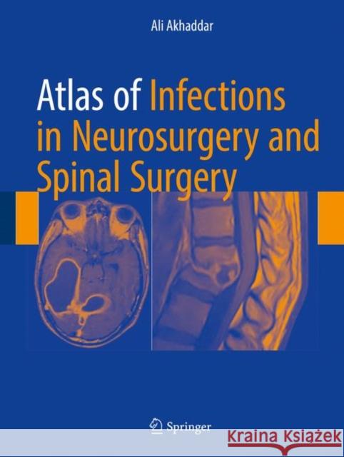 Atlas of Infections in Neurosurgery and Spinal Surgery Ali Akhaddar 9783319600857 Springer - książka