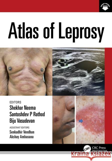 Atlas of Leprosy Shekhar Neema Santoshdev Rathod Biju Vasudevan 9781032209234 CRC Press - książka
