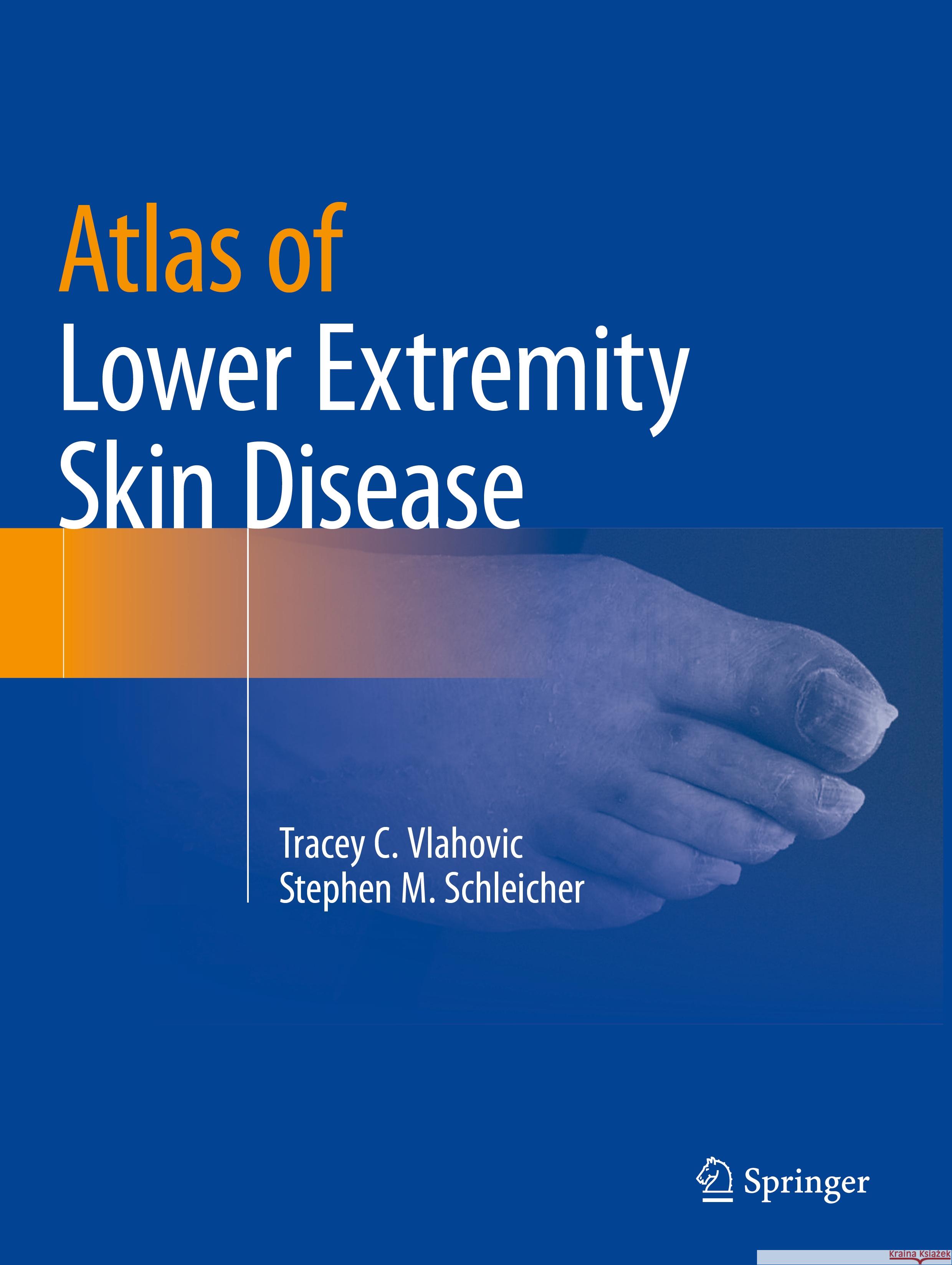 Atlas of Lower Extremity Skin Disease Tracey C. Vlahovic, Stephen M. Schleicher 9783031079528 Springer International Publishing - książka