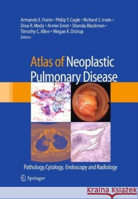 Atlas of Neoplastic Pulmonary Disease: Pathology, Cytology, Endoscopy and Radiology Fraire, Armando E. 9781489979063 Springer - książka