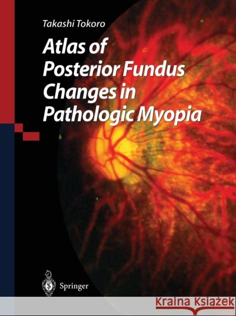 Atlas of Posterior Fundus Changes in Pathologic Myopia Takashi Tokoro 9784431680185 Springer - książka