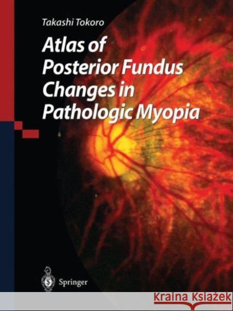 Atlas of Posterior Fundus Changes in Pathologic Myopia Takashi Tokoro T. Tokoro 9784431702252 Springer - książka