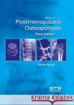 Atlas of Postmenopausal Osteoporosis: Third Edition Rizzoli, Rene 9781858734439 Springer Healthcare - książka