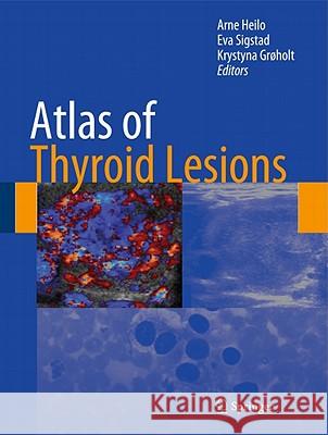 Atlas of Thyroid Lesions Arne Heilo Eva Sigstad Krystyna Groeholt 9781441960092 Springer, Berlin - książka