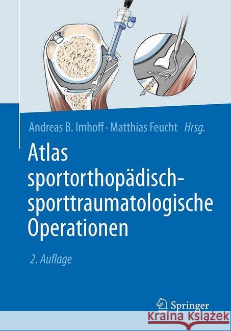 Atlas Sportorthopädisch-Sporttraumatologische Operationen Imhoff, Andreas B. 9783662548349 Springer - książka