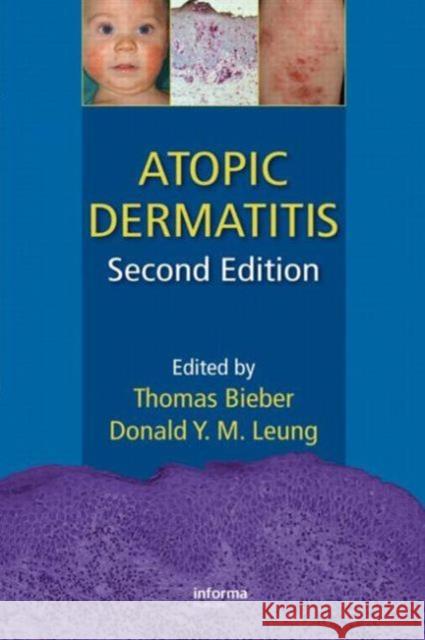 Atopic Dermatitis Thomas Bieber Donald Y. M. Leung 9781420077988 Informa Healthcare - książka