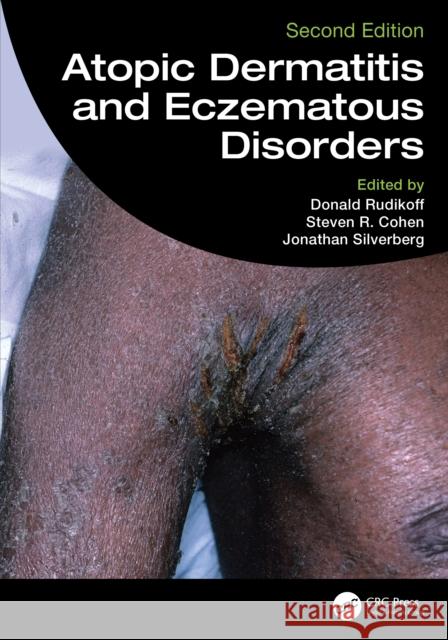 Atopic Dermatitis and Eczematous Disorders Donald Rudikoff Steven R. Cohen Jonathan Silverberg 9780367467371 CRC Press - książka