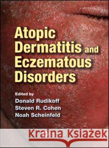 Atopic Dermatitis and Eczematous Disorders Donald Rudikoff Steven R. Cohen Noah Scheinfeld 9781840761955 CRC Press - książka