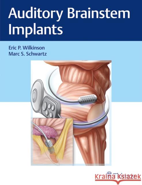 Auditory Brainstem Implants Eric Wilkinson Marc Schwartz 9781626238268 Thieme Medical Publishers - książka