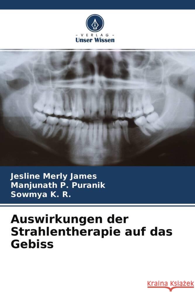 Auswirkungen der Strahlentherapie auf das Gebiss James, Jesline Merly, Puranik, Manjunath P., K. R., Sowmya 9786204332994 Verlag Unser Wissen - książka