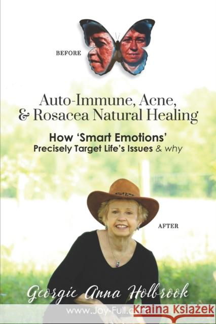 Auto-Immune, Acne, & Rosacea Natural Healing - How 'Smart Emotions' Precisely Target Life's Issues & Why Georgie Anna Holbrook 9781634915564 Booklocker.com - książka