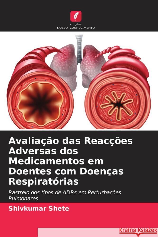 Avaliação das Reacções Adversas dos Medicamentos em Doentes com Doenças Respiratórias Shete, Shivkumar 9786205428535 Edições Nosso Conhecimento - książka