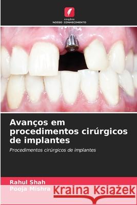 Avan?os em procedimentos cir?rgicos de implantes Rahul Shah Pooja Mishra 9786207635139 Edicoes Nosso Conhecimento - książka