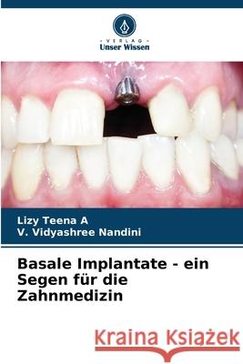 Basale Implantate - ein Segen für die Zahnmedizin A, Lizy Teena, Nandini, V. Vidyashree 9786206834663 Verlag Unser Wissen - książka