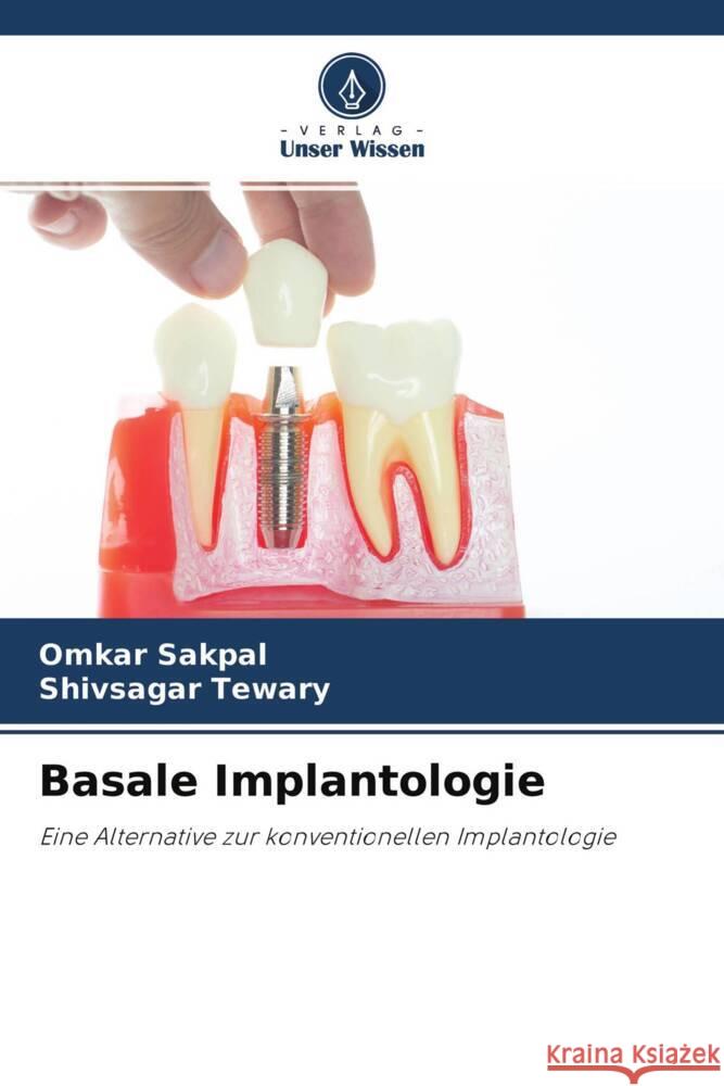 Basale Implantologie Sakpal, Omkar, Tewary, Shivsagar 9786202981651 Verlag Unser Wissen - książka