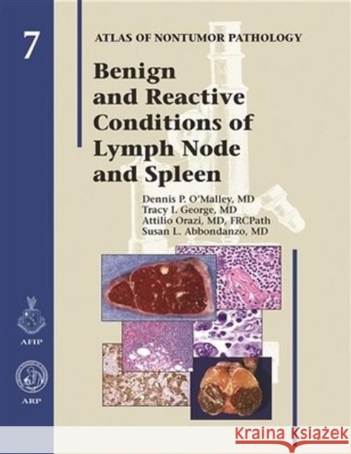 Benign and Reactive Conditions of Lymph Node and Spleen  9781933477060 American Registry of Pathology - książka