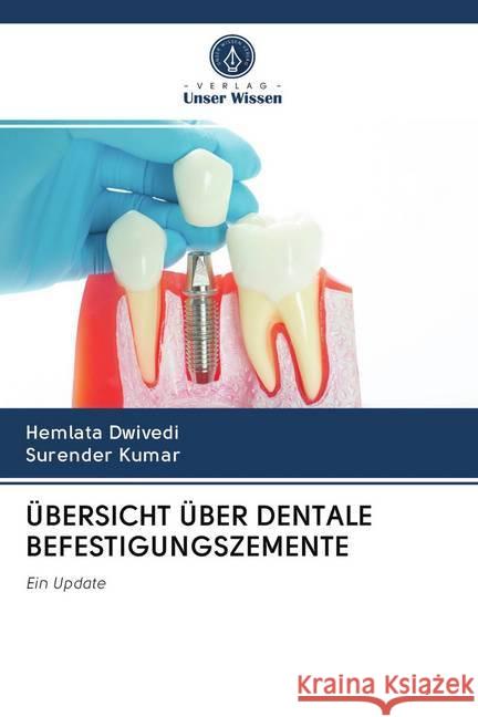 ÜBERSICHT ÜBER DENTALE BEFESTIGUNGSZEMENTE DWIVEDI, HEMLATA; Kumar, Surender 9786202715560 Verlag Unser Wissen - książka