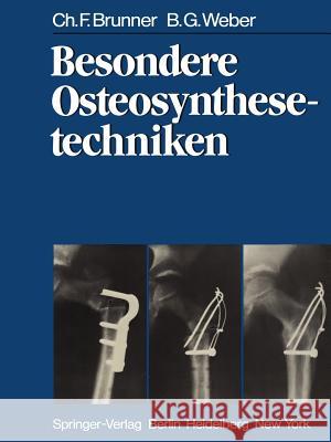 Besondere Osteosynthesetechniken C. F. Brunner B. G. Weber 9783642931819 Springer - książka