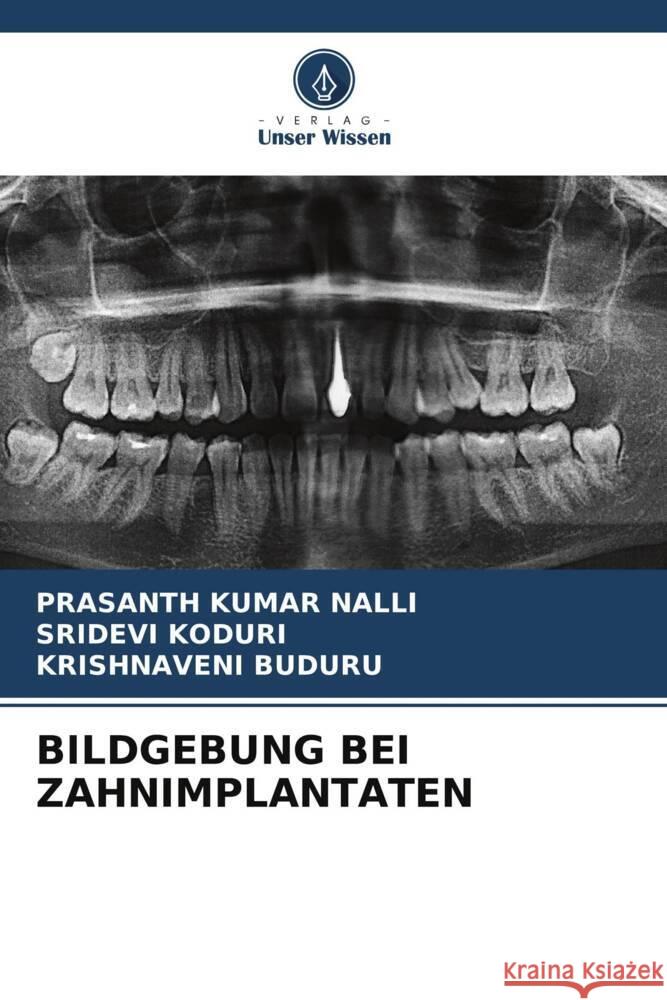 Bildgebung Bei Zahnimplantaten Prasanth Kumar Nalli Sridevi Koduri Krishnaveni Buduru 9786207204281 Verlag Unser Wissen - książka