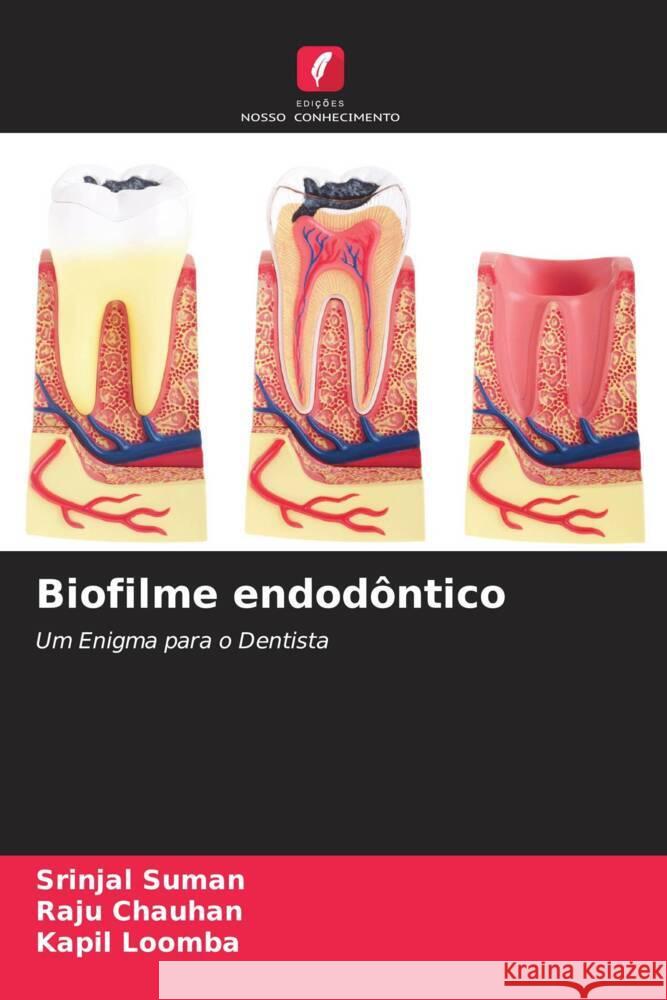 Biofilme endodôntico Suman, Srinjal, Chauhan, Raju, Loomba, Kapil 9786204493671 Edições Nosso Conhecimento - książka