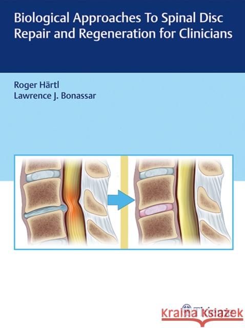 Biological Approaches to Spinal Disc Repair and Regeneration for Clinicians Roger Hartl Larry Bonassar 9781626232501 Thieme Medical Publishers - książka