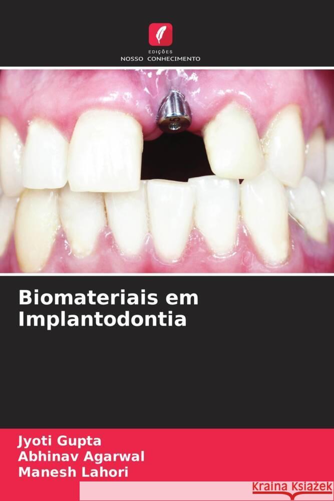 Biomateriais em Implantodontia Gupta, Jyoti, Agarwal, Abhinav, Lahori, Manesh 9786204865539 Edições Nosso Conhecimento - książka