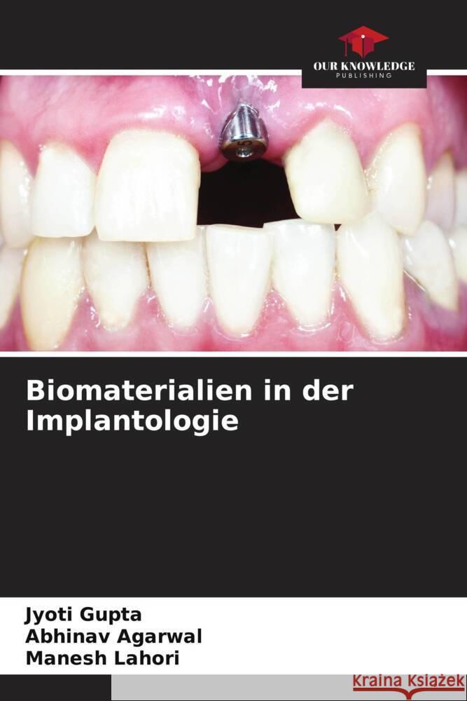 Biomaterialien in der Implantologie Gupta, Jyoti, Agarwal, Abhinav, Lahori, Manesh 9786204865508 Our Knowledge Publishing - książka