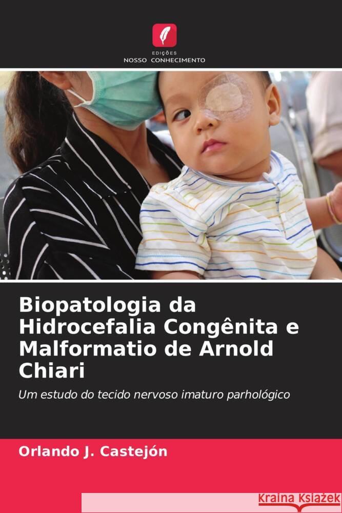 Biopatologia da Hidrocefalia Congênita e Malformatio de Arnold Chiari Castejón, Orlando J. 9786204402925 Edicoes Nosso Conhecimento - książka