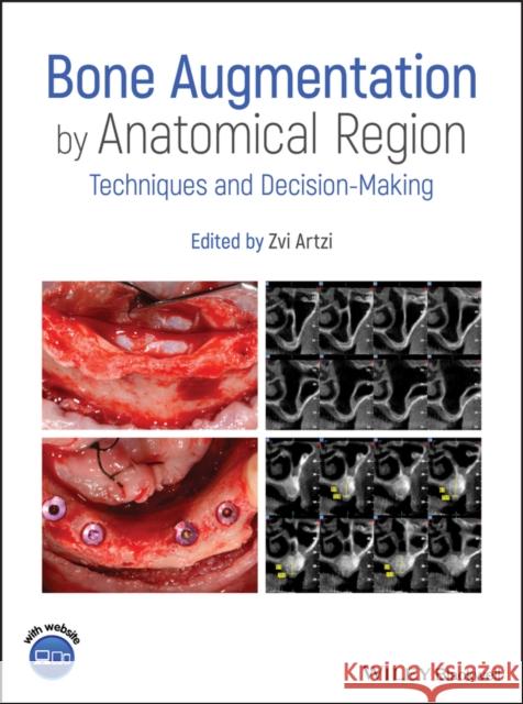 Bone Augmentation by Anatomical Region: Techniques and Decision-Making Artzi, Zvi 9781119427841 Wiley-Blackwell - książka