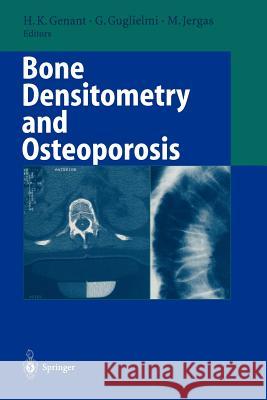 Bone Densitometry and Osteoporosis Harry K. Genant Giuseppe Guglielmi Michael Jergas 9783642804427 Springer - książka